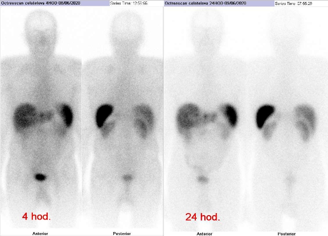 Obr. . 2: Celotlov scintigrafie v pedn a zadn projekci. Vyeten za 4 a 24 hod. po aplikaci radioindiktoru.