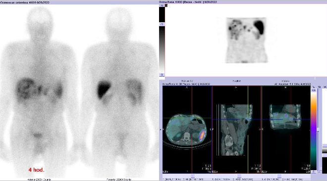 Obr. . 3: Celotlov scintigrafie a fze obraz SPECT a CT  vyeten bicha a pnve 4 hod. po aplikaci radiofarmaka. Zameno na loisko v levm jaternm laloku.
