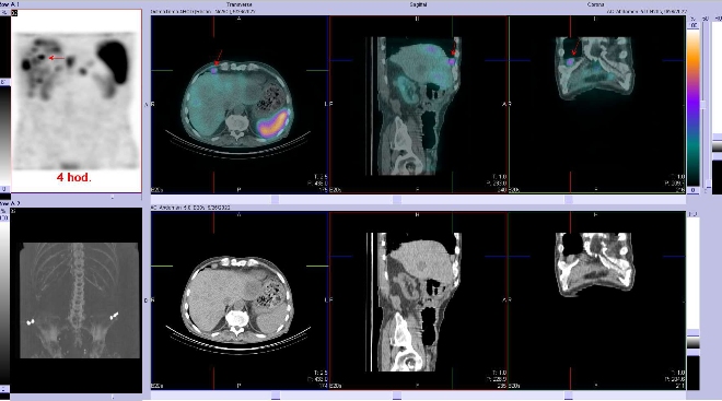 Obr. . 4: Fze obraz SPECT a CT  vyeten bicha a sti pnve 4 hod. po aplikaci radiofarmaka. Zameno na loisko v pravm jaternm laloku.