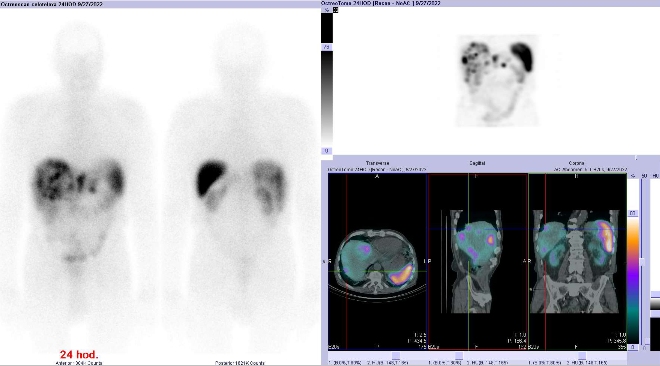 Obr. . 6: Celotlov scintigrafie a fze obraz SPECT a CT  vyeten bicha a pnve 24 hod. po aplikaci radiofarmaka. Zameno na loisko v pravm jaternm laloku.