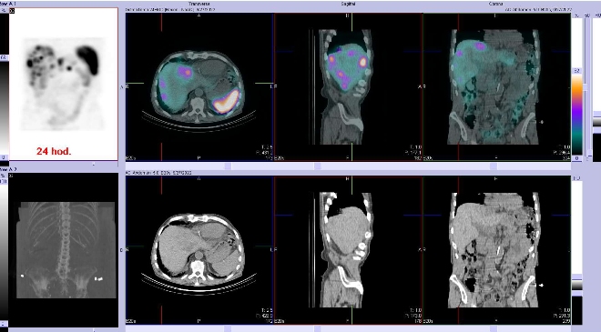 Obr. . 7: Fze obraz SPECT a CT  vyeten bicha a sti pnve 4 hod. po aplikaci radiofarmaka. Zameno na loisko v pravm jaternm laloku.