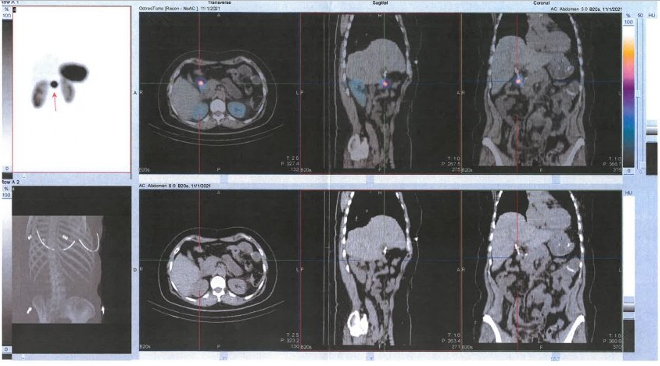Obr. č. 3: Fúze SPECT/CT břicha a pánve 4 hod. po aplikaci OctreoScanu. Zaměřeno na lymfatickou uzlinu při hlavě pankreatu.
