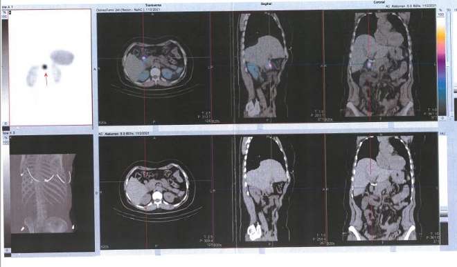 Obr. č. 4: Fúze SPECT/CT břicha a pánve 24 hod. po aplikaci OctreoScanu. Zaměřeno na ložisko v uzlině při hlavě pankreatu.