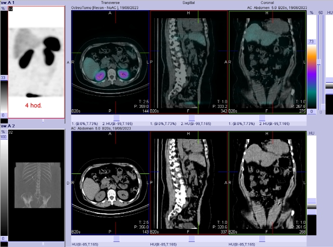 Obr. č. 6: Fúze SPECT/CT břicha a pánve 4 hod. po aplikaci OctreoScanu.