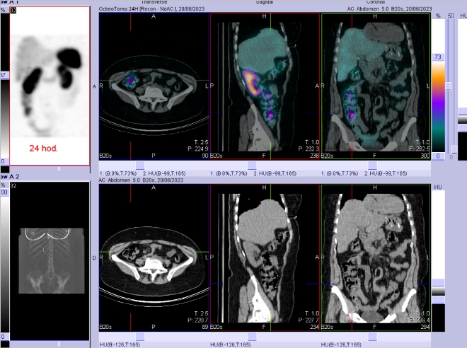 Obr. č. 7: Fúze SPECT/CT břicha a pánve 24 hod. po aplikaci OctreoScanu.