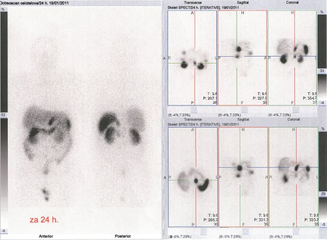 Obr. č. 2: Celotělová scintigrafie a SPECT břicha a pánve 24 hod. po aplikaci radiofarmaka. Vyšetření v roce 2011.