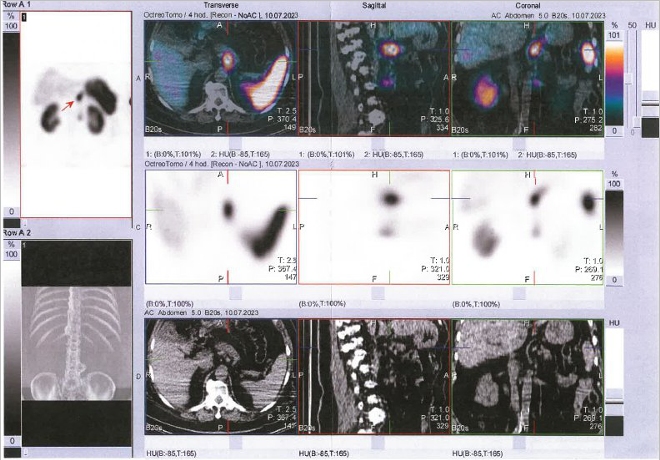 Obr. č. 4: SPECT/CT břicha a pánve 4 hod. po aplikaci OctreoScanu.