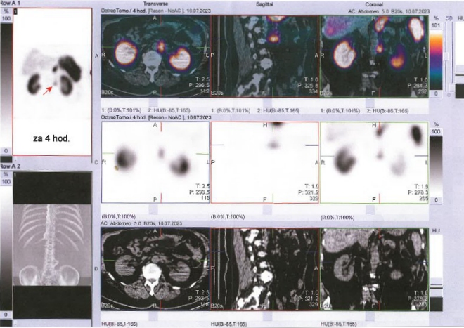 Obr. č. 5: SPECT/CT břicha a pánve 4 hod. po aplikaci OctreoScanu.