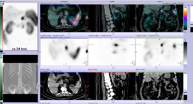 Obr. č. 6: SPECT/CT břicha a pánve 24 hod. po aplikaci OctreoScanu.