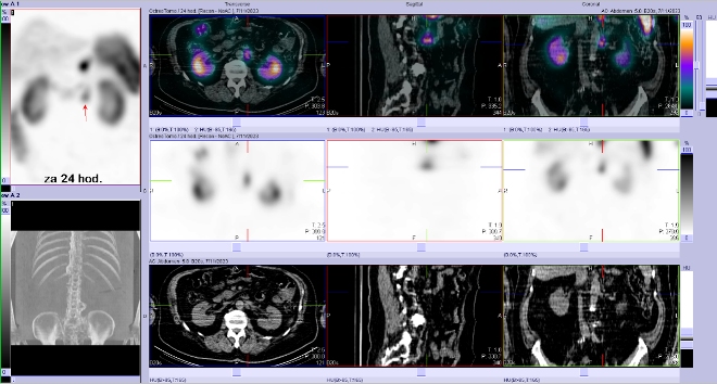 Obr. č. 7: SPECT/CT břicha a pánve 24 hod. po aplikaci OctreoScanu.