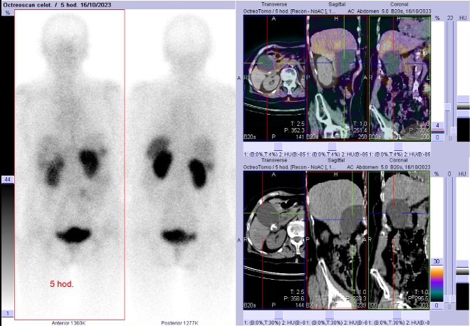 Obr. č. 2: Celotělová scintigrafie a fúze SPECT/CT břicha a pánve 5 hod. po aplikaci OctreoScanu. Zaměřeno na zvětšený žlučník.