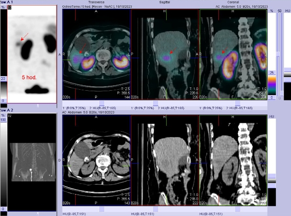 Obr. č. 3: Fúze SPECT/CT břicha a pánve 5 hod. po aplikaci OctreoScanu. Zaměřeno na ložisko v pravém jaterním laloku.