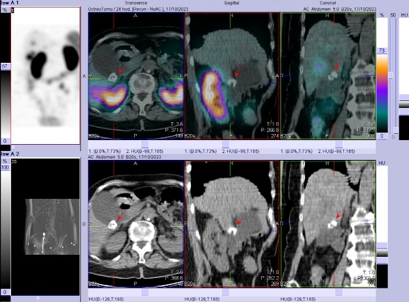 Obr. č. 5: Fúze SPECT/CT břicha a pánve 24 hod. po aplikaci OctreoScanu. Zaměřeno na kámen ve žlučníku.