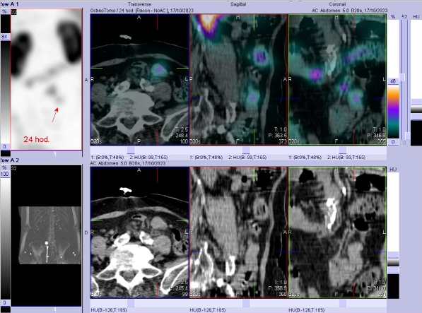 Obr. č. 7: Fúze SPECT/CT břicha a pánve 24 hod. po aplikaci OctreoScanu. Zaměřeno na lymfatickou uzlinu.
