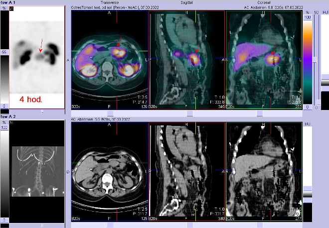 Obr. č. 1: Fúze obrazů SPECT a CT – vyšetření 4 hod. po aplikaci radiofarmaka. Zaměřeno na ložisko v pankreatu.
