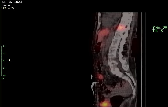 Obr. č. 6 - 12: Fúze obrazů SPECT a CT – vyšetření 24 hod. po aplikaci radiofarmaka.