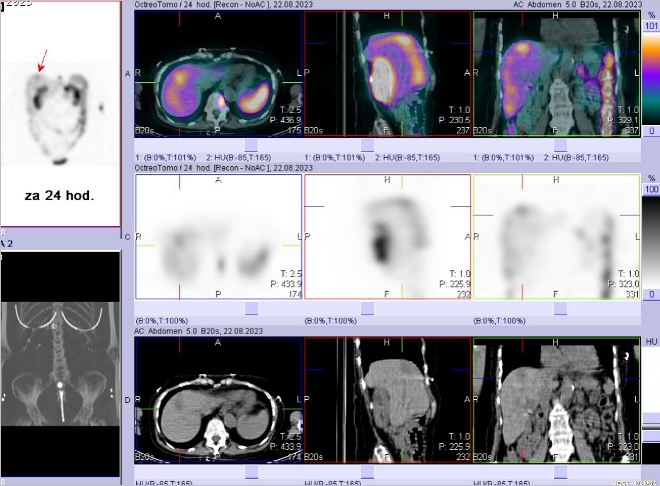 Obr. č. 6 - 12: Fúze obrazů SPECT a CT – vyšetření 24 hod. po aplikaci radiofarmaka.
