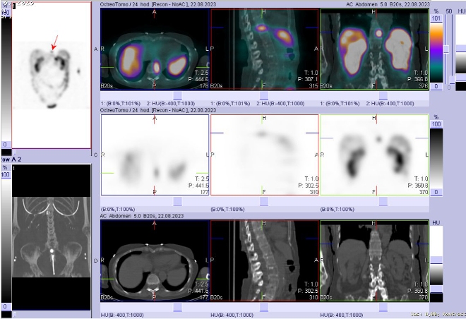 Obr. č. 6 - 12: Fúze obrazů SPECT a CT – vyšetření 24 hod. po aplikaci radiofarmaka.
