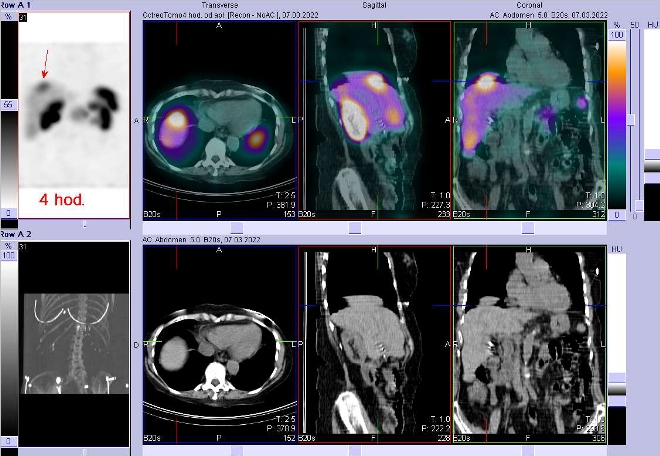 Obr. č. 2: Fúze obrazů SPECT a CT – vyšetření 4 hod. po aplikaci radiofarmaka. Zaměřeno na ložisko v kraniální části pravého jaterního laloku.