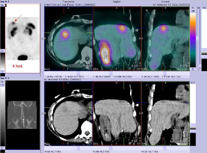 Obr. č. 3: Fúze obrazů SPECT a CT – vyšetření 4 hod. po aplikaci radiofarmaka. Zaměřeno na ložisko v kraniální části pravého jaterního laloku.