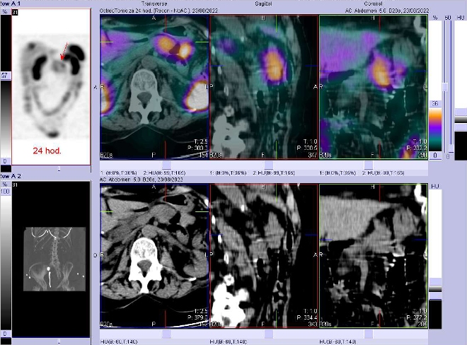 Obr. č. 4: Fúze obrazů SPECT a CT – vyšetření 24 hod. po aplikaci radiofarmaka. Zaměřeno na ložisko v pankreatu.