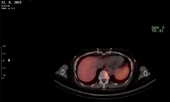 Obr. č. 6 - 12: Fúze obrazů SPECT a CT – vyšetření 24 hod. po aplikaci radiofarmaka.