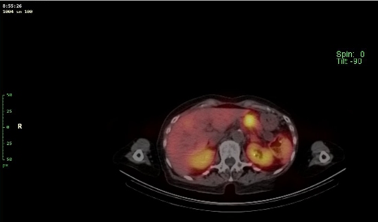 Obr. č. 6 - 12: Fúze obrazů SPECT a CT – vyšetření 24 hod. po aplikaci radiofarmaka.
