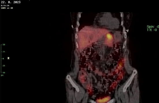 Obr. č. 6 - 12: Fúze obrazů SPECT a CT – vyšetření 24 hod. po aplikaci radiofarmaka.