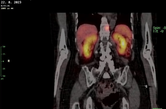 Obr. č. 6 - 12: Fúze obrazů SPECT a CT – vyšetření 24 hod. po aplikaci radiofarmaka.