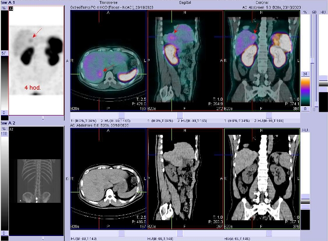 Obr. č. 2: Fúze SPECT/CT břicha a pánve 4 hod. po aplikaci OctreoScanu. Zaměřeno na ložisko v pravém jaterním laloku.