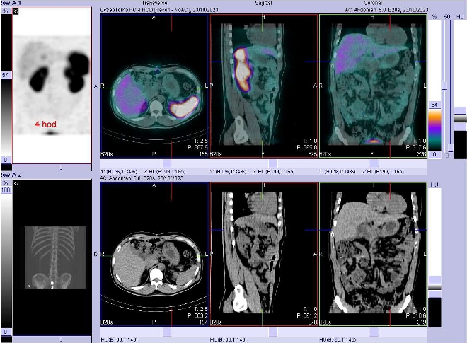 Obr. č. 3: Fúze SPECT/CT břicha a pánve 4 hod. po aplikaci OctreoScanu. Zaměřeno na žaludek.