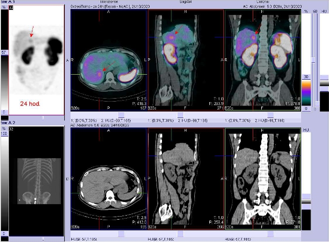 Obr. č. 5: Fúze SPECT/CT břicha a pánve 24 hod. po aplikaci OctreoScanu. Zaměřeno na ložisko v pravém jaterním laloku.