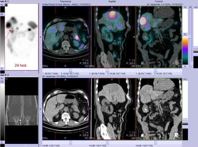 Obr. č. 10: Fúze SPECT/CT břicha a pánve 24 hod. po aplikaci OctreoScanu. Zaměřeno na ložisko v pravém jaterním laloku.