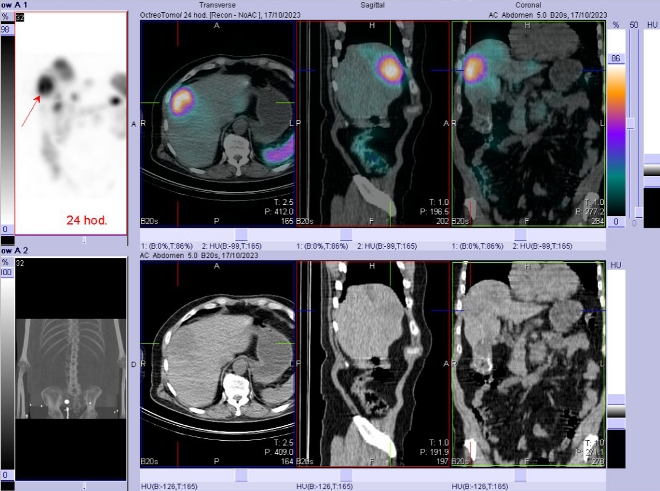 Obr. č. 11: Fúze SPECT/CT břicha a pánve 24 hod. po aplikaci OctreoScanu. Zaměřeno na ložisko v pravém jaterním laloku.