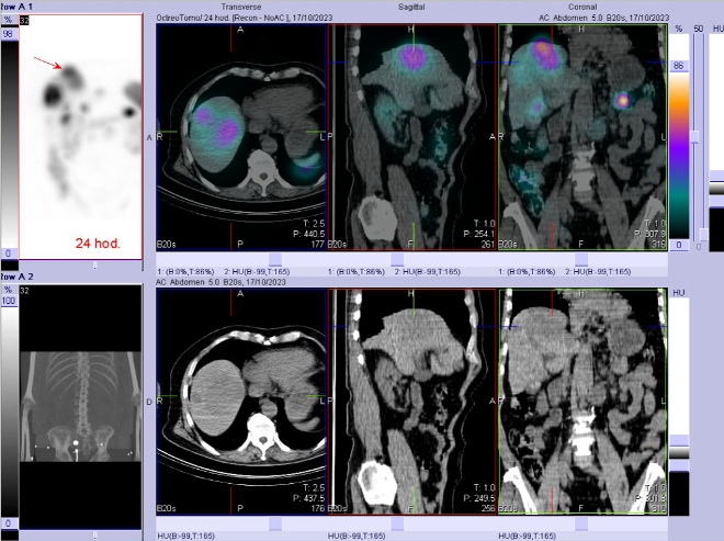 Obr. č. 12: Fúze SPECT/CT břicha a pánve 24 hod. po aplikaci OctreoScanu. Zaměřeno na ložisko v pravém jaterním laloku.