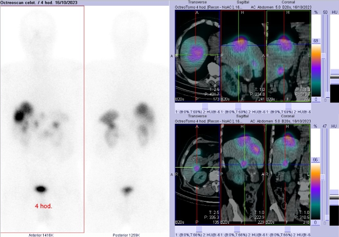 Obr.č.2: Celotělová scintigrafie a fúze SPECT/CT břicha a pánve 4 hod. po aplikaci OctreoScanu. Zaměřeno na ložisko v pravém jaterním laloku.