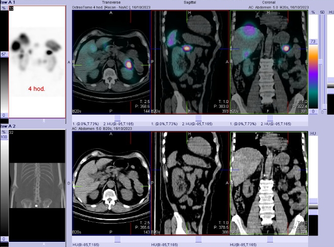 Obr. č. 3: Fúze SPECT/CT břicha a pánve 4 hod. po aplikaci OctreoScanu. Zaměřeno na ložisko v kaudě pankreatu.