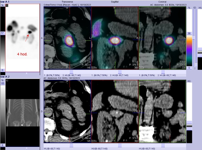 Obr. č. 4: Fúze SPECT/CT břicha a pánve 4 hod. po aplikaci OctreoScanu. Zaměřeno na ložisko v kaudě pankreatu.