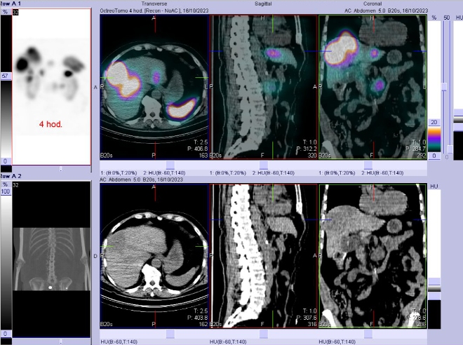 Obr. č. 5: Fúze SPECT/CT břicha a pánve 4 hod. po aplikaci OctreoScanu. Zaměřeno na ložisko v levém jaterním laloku.