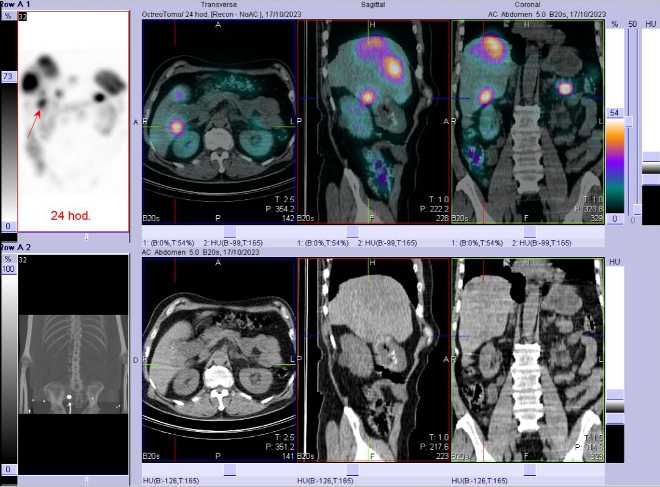 Obr. č. 6: Fúze SPECT/CT břicha a pánve 24 hod. po aplikaci OctreoScanu. Zaměřeno na ložisko v pravém jaterním laloku.
