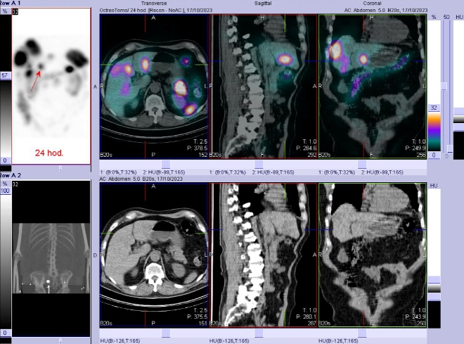 Obr. č. 7: Fúze SPECT/CT břicha a pánve 24 hod. po aplikaci OctreoScanu. Zaměřeno na ložisko v pravém jaterním laloku.