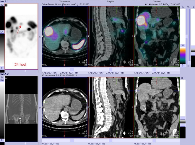 Obr. č. 8: Fúze SPECT/CT břicha a pánve 24 hod. po aplikaci OctreoScanu. Zaměřeno na ložisko v levém jaterním laloku.