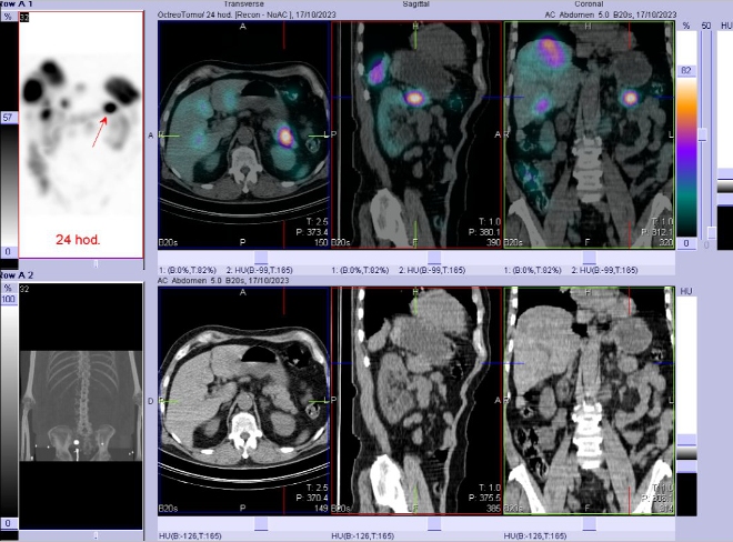 Obr. č. 9: Fúze SPECT/CT břicha a pánve 24 hod. po aplikaci OctreoScanu. Zaměřeno na ložisko v kaudě pankreatu.
