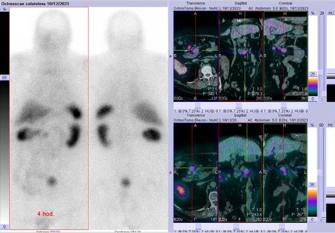 Obr. . 1: Celotlov scintigrafie a SPECT/CT 4 hod. po aplikaci OctreoScanu.