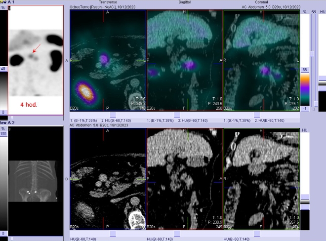 Obr. . 3: Fze SPECT/CT bicha a pnve 4 hod. po aplikaci OctreoScanu. Zameno na loisko v uzlin v mezenteriu.
