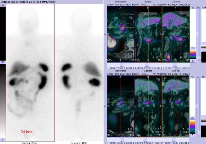 Obr. . 5: Celotlov scintigrafie a SPECT/CT 24 hod. po aplikaci OctreoScanu.