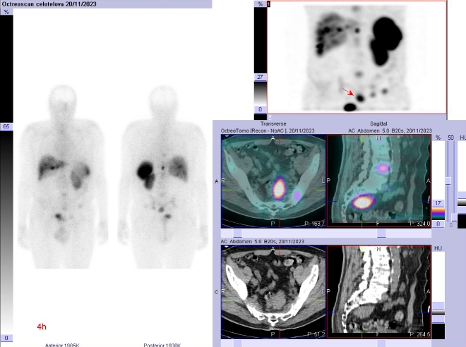 Obr. č. 1: Celotělová scintigrafie a SPECT/CT za 4 hod. po aplikaci OctreoScanu.