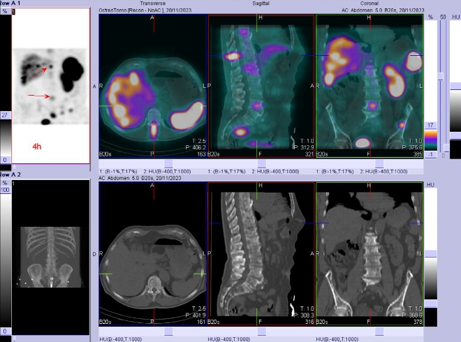 Obr. č. 2: SPECT/CT za 4 hod. po aplikaci OctreoScanu.