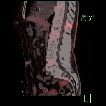 Obr. č. 3: SPECT/CT za 4 hod. po aplikaci OctreoScanu.