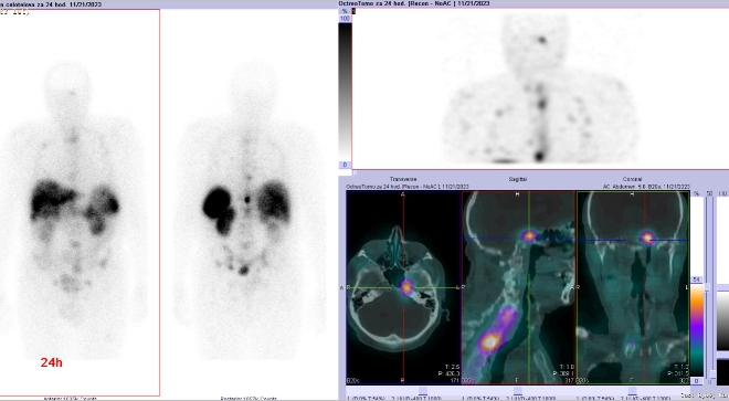 Obr. č. 4: Celotělová scintigrafie a SPECT/CT za 24 hod. po aplikaci OctreoScanu.